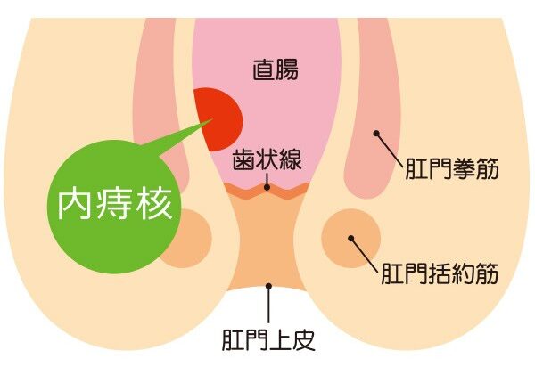 内痔核について