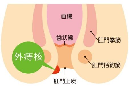 外痔核・血栓性外痔核について