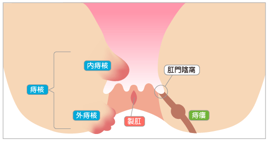 いぼ痔（痔核）とは