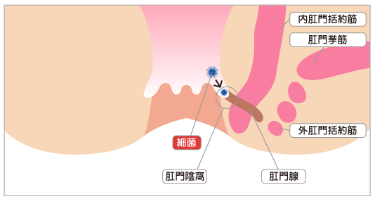 肛門周囲膿瘍とは