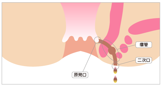 肛門周囲膿瘍が進行して痔ろうを発症します