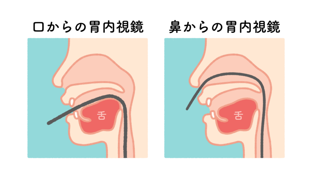 楽に受けられる経鼻内視鏡検査